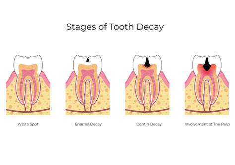 cavity goon|cavities in kids under 5.